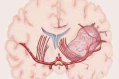 A-Linha-de-Porto-Alegre-Um-Novo-Conceito-Cirurgico-para-Gliomas-do-Lobo-da-Insula-2