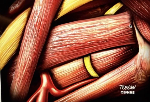 Ilustração anatômica em close mostrando nervos em amarelo entre feixes musculares vermelhos e vasos sanguíneos, com identificação do CEANNE no canto inferior direito.